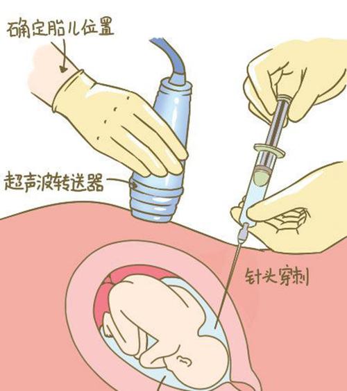 台州羊水孕期亲子鉴定